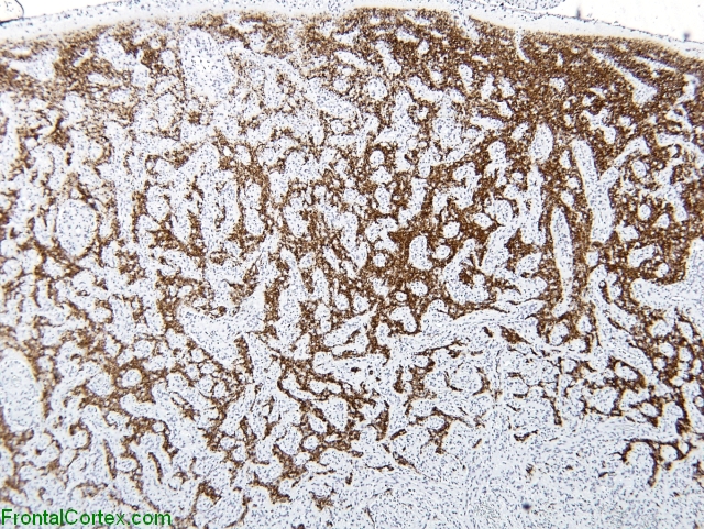 Angiocentric glioma, synaptophysin immunohistochemical staining x 20